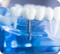 dental implants