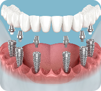 dental implants