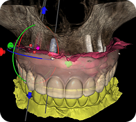 dental implants