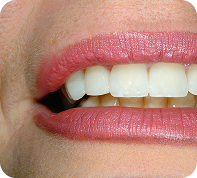 smile makeover